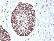 IHC staining of FFPE human cervix with recombinant SOX2 antibody (clone rSOX2/1791). HIER: boil tissue sections in pH 9 10mM Tris with 1mM EDTA for 10-20 min and allow to cool before testing.