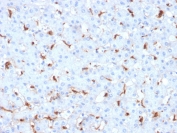 IHC staining of FFPE human hepatocellular carcinoma with C1QB antibody (clone C1QB/2961). HIER: boil tissue sections in pH 9 10mM Tris with 1mM EDTA for 20 min and allow to cool before testing.