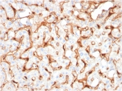 IHC staining of FFPE human hepatocellular carcinoma with Complement C1q B-Chain antibody (clone C1QB/2965). HIER: boil tissue sections in pH 9 10mM Tris with 1mM EDTA for 20 min and allow to cool before testing.