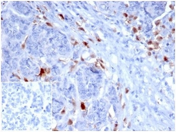 IHC staining of FFPE human ovarian carcinoma with SREBP1 antibody (clone SREBP1/1578). HIER: boil tissue sections in pH