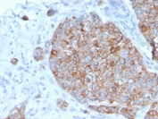 IHC staining of FFPE human prostate carcinoma with STAT2 antibody (clone STAT2/2650). HIER: boil tissue sections in pH 9 10mM Tris with 1mM EDTA for 20 min and allow to cool before testing.