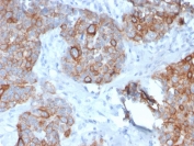 IHC staining of FFPE human prostate carcinoma with STAT2 antibody (clone STAT2/2650). HIER: boil tissue sections in pH 9 10mM Tris with 1mM EDTA for 20 min and allow to cool before testing.