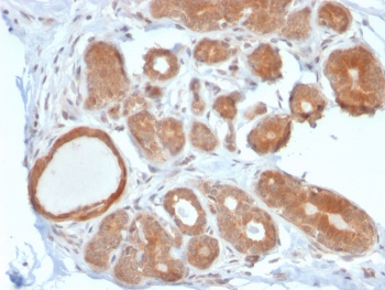 IHC staining of FFPE human breast carcinoma with STAT5b antibody. HIER: boil tissue sections in pH 9 10mM Tris with 1mM EDTA for 20 min and allow to cool before testing.~