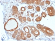 IHC staining of FFPE human breast carcinoma with STAT5b antibody (clone STAT5B/2611). HIER: boil tissue sections in pH 9 10mM Tris with 1mM EDTA for 20 min and allow to cool before testing.