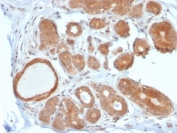 IHC staining of FFPE human breast carcinoma with STAT5b antibody (clone STAT5B/2611). HIER: boil tissue sections in pH 9 10mM Tris with 1mM EDTA for 20 min and allow to cool before testing.