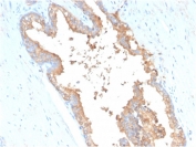 IHC staining of FFPE human prostate carcinoma with Transferrin antibody (clone TF/3001). HIER: boil tissue sections in pH 9 10mM Tris with 1mM EDTA for 20 min and allow to cool before testing.