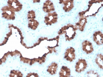 IHC staining of FFPE human breast carcinoma with recombinant pS2 antibody (clone rTFF1/1091). HIER: boil tissue sections in pH 9 10mM Tris with 1mM EDTA for 20 min and allow to cool before testing.~