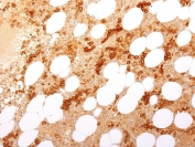 IHC staining of FFPE human bone marrow with recombinant CD71 antibody (clone TFRC/2898R). HIER: boil tissue sections in pH 9 10mM Tris with 1mM EDTA for 20 min and allow to cool before testing.