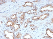 IHC testing of FFPE human prostate carcinoma with recombinant AMACR antibody (clone AMACR/4572R). Required HIER: steam section in pH 9 10mM Tris with 1mM EDTA for 20 min and allow to cool prior to staining.