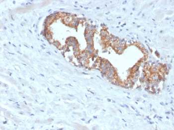 IHC testing of FFPE human prostate carcinoma with recombinant AMACR antibody. Required HIER: steam section in pH 9 10mM Tris with 1mM EDTA for 20 min and allow to cool prior to staining.