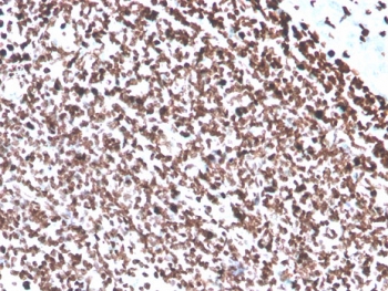 IHC: Formalin-fixed, paraffin-embedded human colon carcinoma stained with recombinant dsDNA antibody (clone DSD/4054R). HIER: boil tissue sections in pH 9 10mM Tris with 1mM EDTA for 10-20 min and allow to cool before testing.~
