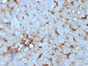 IHC staining of FFPE human renal cell carcinoma with C1QA antibody (clone C1QA/2955). HIER: boil tissue sections in pH 9 10mM Tris with 1mM EDTA for 10-20 min and allow to cool before testing.
