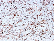 IHC staining of FFPE human liver with C1QA antibody (clone C1QA/2956). HIER: boil tissue sections in pH 9 10mM Tris with 1mM EDTA for 10-20 min and allow to cool before testing.