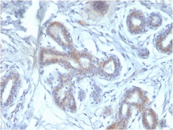 IHC staining of FFPE human breast carcinoma with BAP1 antibody. HIER: boil tissue sections in pH 9 10mM Tris with 1mM EDTA for 10-20 min and allow to cool before testing.