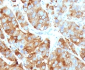 IHC staining of FFPE human prostate carcinoma with Cytokeratin 15 antibody (clone CTKN15-1). HIER: boil tissue sections in pH 9 10mM Tris with 1mM EDTA for 10-20 min and allow to cool before testing.