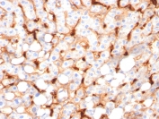 IHC staining of FFPE human hepatocellular carcinoma with C1QB antibody (clone C1QB/2966). HIER: boil tissue sections in pH 9 10mM Tris with 1mM EDTA for 20 min and allow to cool before testing.