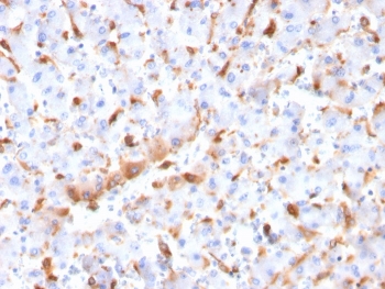 IHC staining of FFPE human hepatocellular carcinoma with C1QB antibody. HIER: boil tissue sections in pH 9 10mM Tris with 1mM EDTA for 20 min and allow to cool before testing.