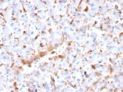 IHC staining of FFPE human hepatocellular carcinoma with C1QB antibody (clone C1QB/2966). HIER: boil tissue sections in pH 9 10mM Tris with 1mM EDTA for 20 min and allow to cool before testing.