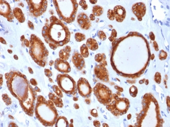 IHC staining of FFPE human thyroid carcinoma with TPO antibody (clone TPO/1921). HIER: boil tissue sections in pH 9 10mM Tris with 1mM EDTA for 20 min and allow to cool before testing.~