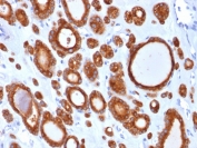 IHC staining of FFPE human thyroid carcinoma with TPO antibody (clone TPO/1921). HIER: boil tissue sections in pH 9 10mM Tris with 1mM EDTA for 20 min and allow to cool before testing.
