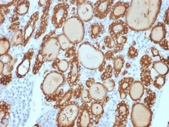 IHC staining of FFPE human thyroid carcinoma with recombinant Thyroid Peroxidase antibody (clone TPO/3813R). HIER: boil tissue sections in pH 9 10mM Tris with 1mM EDTA for 20 min and allow to cool before testing.~
