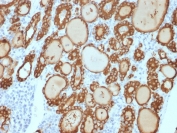 IHC staining of FFPE human thyroid carcinoma with recombinant Thyroid Peroxidase antibody (clone TPO/3813R). HIER: boil tissue sections in pH 9 10mM Tris with 1mM EDTA for 20 min and allow to cool before testing.