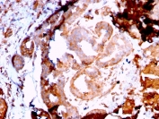 IHC staining of FFPE breast carcinoma with recombinant GRP94 antibody (clone HSP90B1/3168R). HIER: boil tissue sections in pH 9 10mM Tris with 1mM EDTA for 20 min and allow to cool before testing.