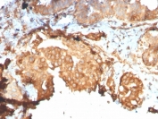 IHC staining of FFPE breast carcinoma with recombinant GRP94 antibody (clone HSP90B1/3168R). HIER: boil tissue sections in pH 9 10mM Tris with 1mM EDTA for 20 min and allow to cool before testing.