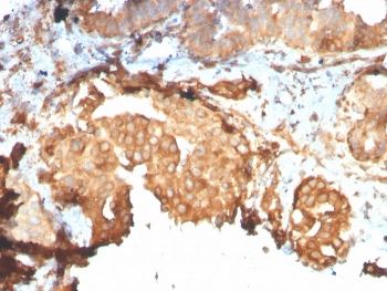 IHC staining of FFPE breast carcinoma with recombinant GRP94 antibody (clone HSP90B1/3168R). HIER: boil tissue sections in pH 9 10mM Tris with 1mM EDTA for 20 min and allow to cool before testing.