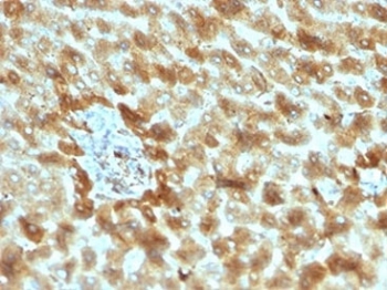 IHC staining of FFPE human hepatocellular carcinoma tissue with Complement 3d antibody (clone C3D/2891). HIER: boil tissue sections in pH 9 10mM Tris with 1mM EDTA for 20 min and allow to cool before testing.