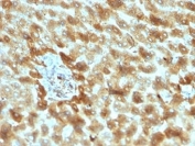 IHC staining of FFPE human hepatocellular carcinoma tissue with Complement 3d antibody (clone C3D/2891). HIER: boil tissue sections in pH 9 10mM Tris with 1mM EDTA for 20 min and allow to cool before testing.