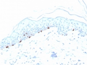 IHC staining of FFPE human skin with Tyrosinase-Related Protein-1 antibody (clone TYRP1/3280). HIER: boil tissue sections in pH 9 10mM Tris with 1mM EDTA for 20 min and allow to cool before testing.
