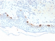 IHC staining of FFPE human skin with Tyrosinase-Related Protein-1 antibody (clone TYRP1/3281). HIER: boil tissue sections in pH 9 10mM Tris with 1mM EDTA for 20 min and allow to cool before testing.