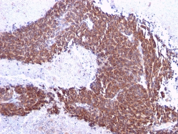 IHC staining of FFPE human melanoma with TOP1MT antibody (clone TOP1MT/613). HIER: boil tissue sections in pH 9 10mM Tris with 1mM EDTA for 20 min and allow to cool before testing.