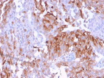 IHC staining of FFPE human urothelial carcinoma with UPK1B antibody. HIER: boil tissue sections in pH 9 10mM Tris with 1mM EDTA for 20 min and allow to cool before testing.