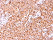 IHC staining of FFPE human urothelial carcinoma with UPK1B antibody (clone UPK1B/3081). HIER: boil tissue sections in pH 9 10mM Tris with 1mM EDTA for 20 min and allow to cool before testing.