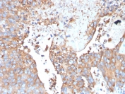 IHC staining of FFPE human urothelial carcinoma with Uroplakin 1B antibody (clone UPK1B/3273). HIER: boil tissue sections in pH 9 10mM Tris with 1mM EDTA for 20 min and allow to cool before testing.