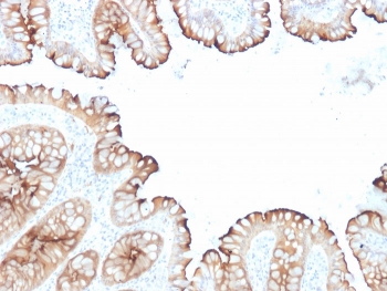 IHC staining of FFPE human colon carcinoma with Villin antibody cocktail (clones VIL1/1314 + VIL1/2376). HIER: boil tissue sections in pH 9 10mM Tris with 1mM EDTA for 20 min and allow to cool before testing.~