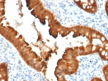 IHC staining of FFPE human colon carcinoma with Villin antibody (clone VIL1/2376). HIER: boil tissue sections in pH 9 10mM Tris with 1mM EDTA for 20 min and allow to cool before testing.~