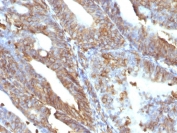 IHC staining of FFPE human uterine carcinoma with Vimentin antibody (clone V9). HIER: boil tissue sections in pH 9 10mM Tris with 1mM EDTA for 20 min and allow to cool before testing.