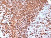 IHC staining of FFPE human prostate carcinoma with Vimentin antibody (clone VIM/3736). HIER: boil tissue sections in pH 9 10mM Tris with 1mM EDTA for 20 min and allow to cool before testing.