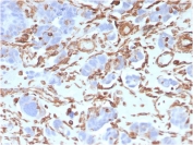 IHC staining of FFPE human colon carcinoma with Vimentin antibody (clone VIM/3736). HIER: boil tissue sections in pH 9 10mM Tris with 1mM EDTA for 20 min and allow to cool before testing.