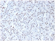 IHC staining of FFPE human mesothelioma with WT1 antibody. HIER: boil tissue sections in pH 9 10mM Tris with 1mM EDTA for 20 min and allow to cool before testing.
