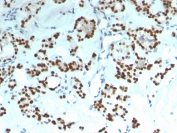 IHC staining of FFPE human thyroid with recombinant PAX8 antibody (clone rPAX8/1492). HIER: boil tissue sections in pH 9 10mM Tris with 1mM EDTA for 20 min and allow to cool before testing.