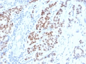 IHC staining of FFPE human breast carcinoma with Estrogen Receptor alpha antibody (clone ESR1/4008). HIER: boil tissue sections in pH 9 10mM Tris with 1mM EDTA for 20 min and allow to cool before testing.