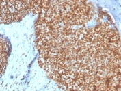 IHC staining of FFPE human breast with Estrogen Receptor alpha antibody (clone ESR1/4008). HIER: boil tissue sections in pH 9 10mM Tris with 1mM EDTA for 20 min and allow to cool before testing.