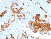 IHC testing of FFPE human mesothelioma with CALB2 antibody (clone CALB2/2602). HIER: boil tissue sections in pH 9 10mM Tris with 1mM EDTA for 10-20 min followed by cooling at RT for 20 min.