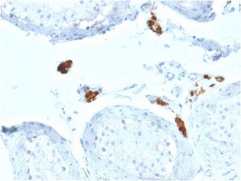 IHC testing of FFPE human testicular carcinoma with CALB2 antibody. HIER: boil tissue sections in pH 9 10mM Tris with 1mM EDTA for 10-20 min followed by cooling at RT for 20 min.