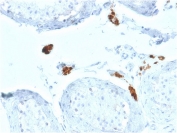 IHC testing of FFPE human testicular carcinoma with CALB2 antibody (clone CALB2/2602). HIER: boil tissue sections in pH 9 10mM Tris with 1mM EDTA for 10-20 min followed by cooling at RT for 20 min.