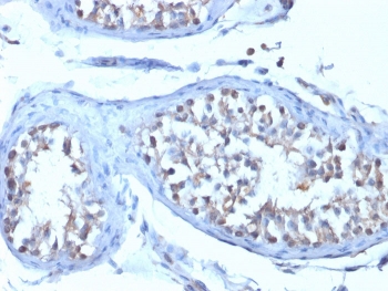 IHC staining of FFPE human testicular carcinoma with B7-H4 antibody (clone B7H4/1788). HIER: boil tissue sections in pH 9 10mM Tris with 1mM EDTA for 20 min and allow to cool before testing.